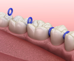 photo of dental spacers
